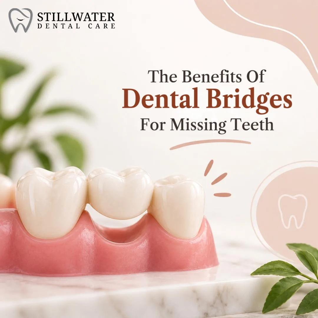 The Benefits Of Dental Bridges For Missing Teeth